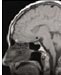 MRI